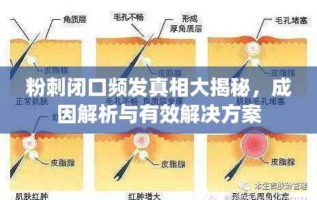 粉刺闭口频发真相大揭秘,成因解析与有效解决方案