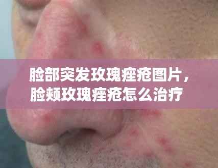 脸部突发玫瑰痤疮图片，脸颊玫瑰痤疮怎么治疗 